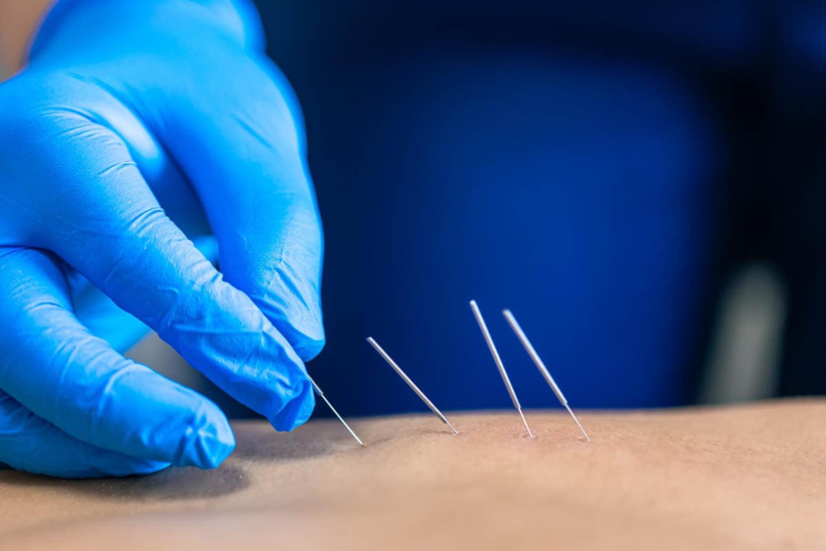 Dry Needling and Cupping Therapy